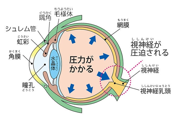 緑内障とは