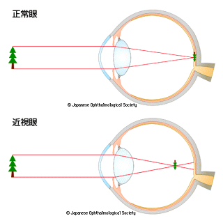 近視について