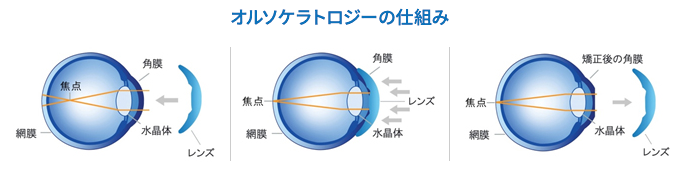 オルソケラトロジーの仕組み